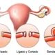 Does tubal ligation have medical consequences?